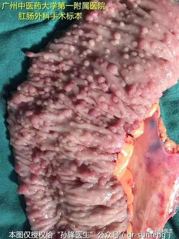 家族性腺瘤性息肉病诊断六问六答