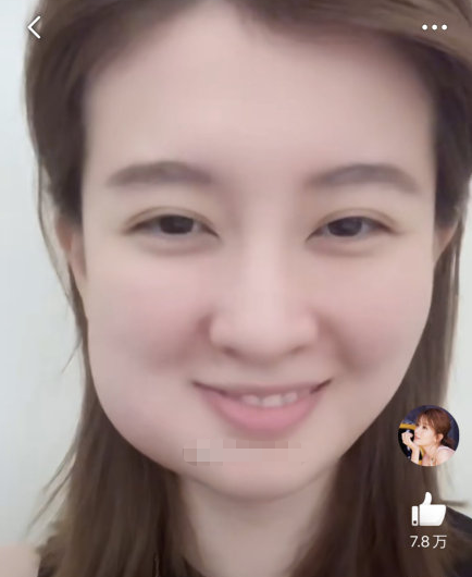 明星拔智齿脸肿 周冬雨笑哭 乔欣可爱 看到刘宪华 智齿界名人 腾讯新闻