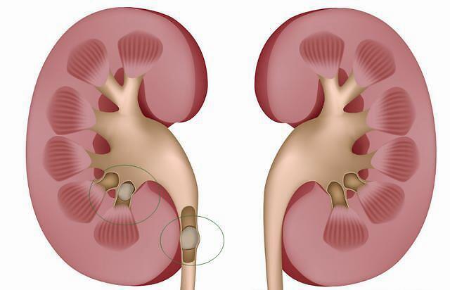 肾结石首选治疗方式体外碎石,然而这几种情况就得乖乖手术了!