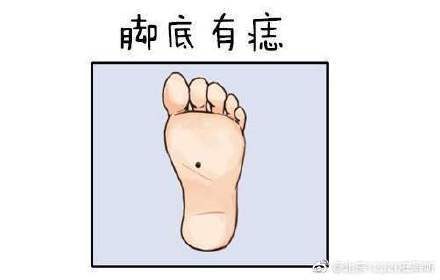 脚底长痣就是黑色素瘤吗