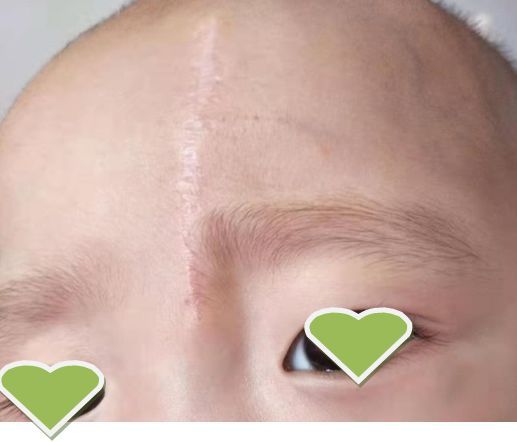 巧用超减张缝合技术还孩子美丽面庞