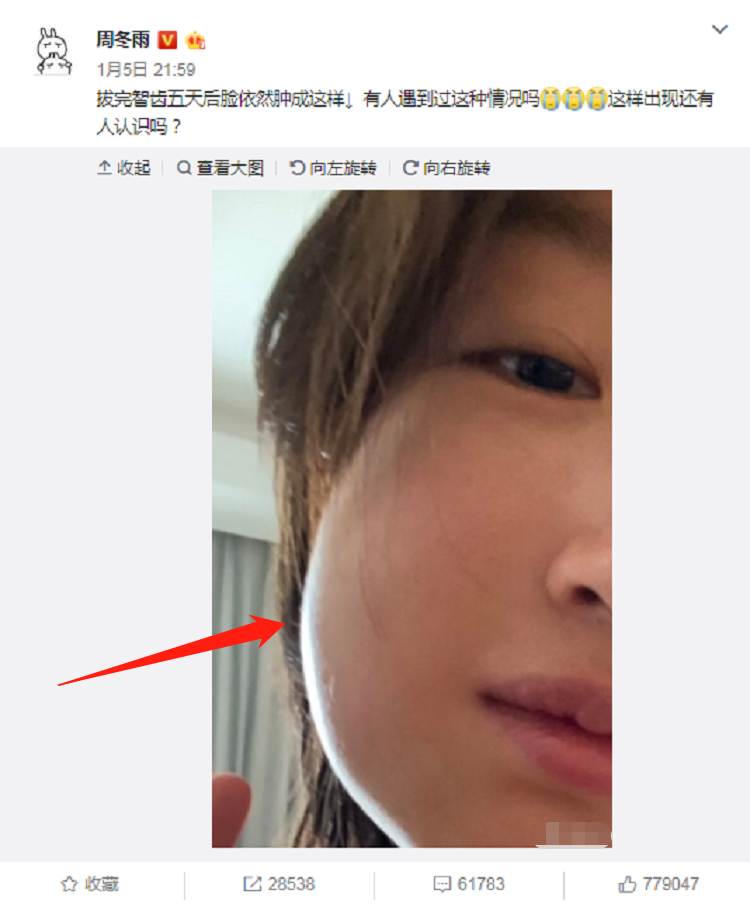 周冬雨拔掉智齿 脸肿到上网求救 谁知评论区却成了 比丑大赛 腾讯新闻