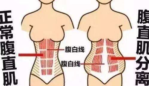 腹直肌分离|产后|腹部肌肉|腹直肌|子宫脱垂