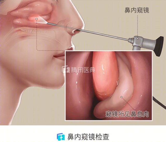 根据长的位置不同,命名不同,比如长在鼻腔,胃肠,胆囊,子宫,膀胱,尿道