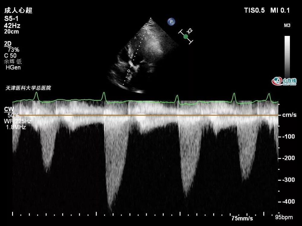 心动在线丨超声如何评估低流速,低压差的主动脉瓣狭窄?
