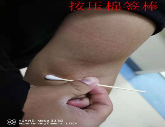 5,知识链接静脉采血部位的选择:成人首选肘正中静脉进行穿刺,也可选择