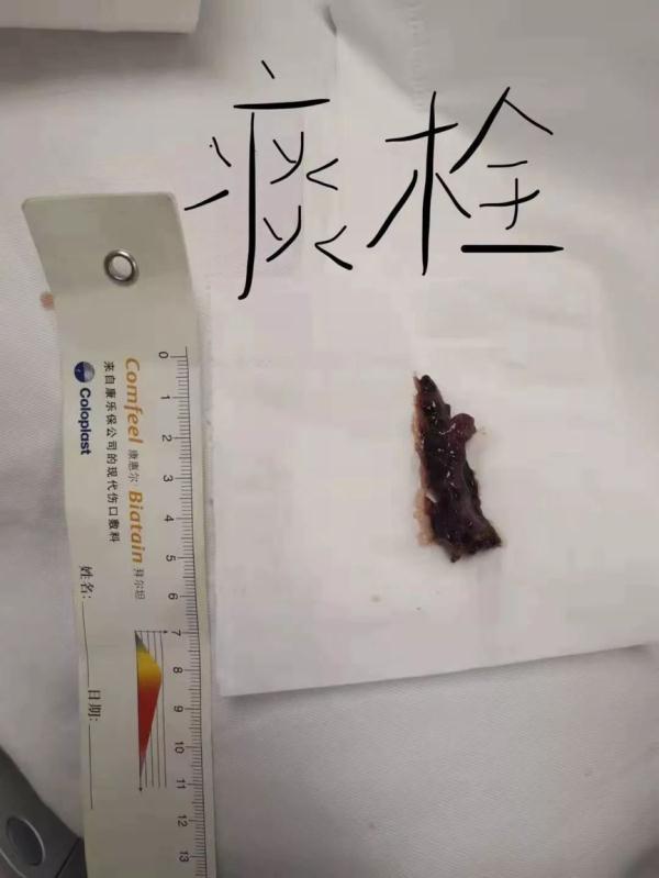 带走老人的往往只是一口痰，有痰咳不出来绝非小事_腾讯新闻