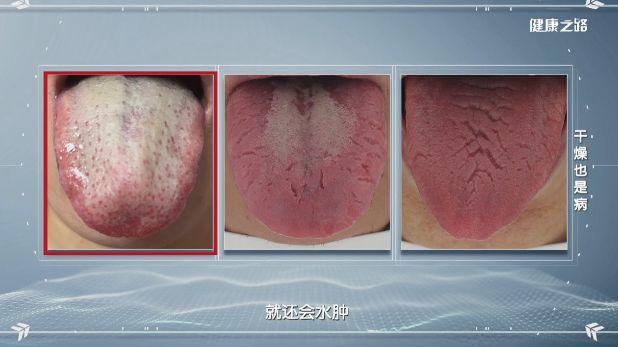 干燥综合征的舌苔正常的舌头,舌体大小适中,舌苔光润;干燥综合征患者