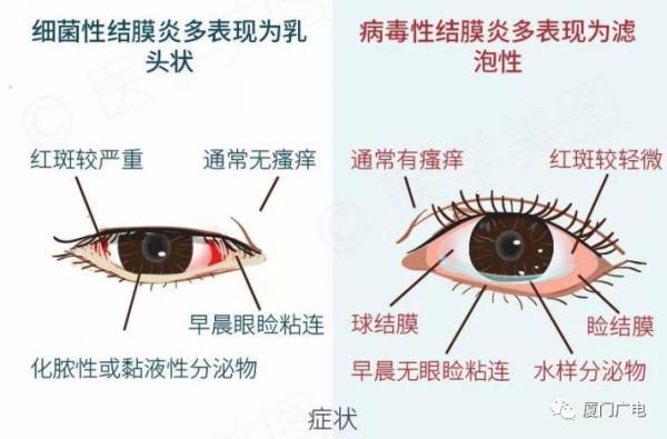 医生提醒红眼病是急性结膜炎的统称其传播途径主要是通过接触传染