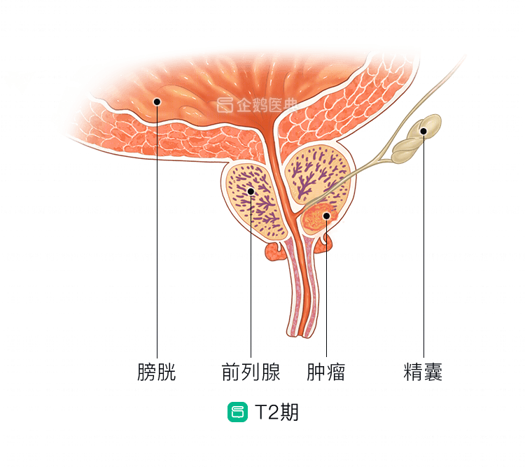 前列腺癌的治療方式雖多但需根據分期精準選擇