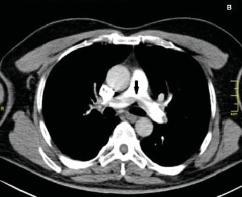 冠心病介入术后常规压了个沙袋,差点要了
