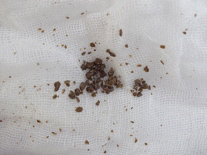 在泌尿系统中,最常见的疾病要属肾结石了,肾结石是一种多发性疾病