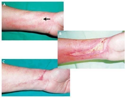 肿瘤化疗输液出现药物外渗,该怎么办?医生:及时处理不然很麻烦