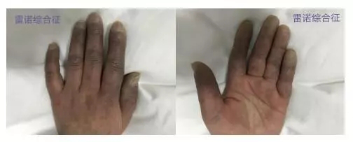 年轻女性手遇寒气"变色" 可能是患了"雷诺病"_腾讯新闻