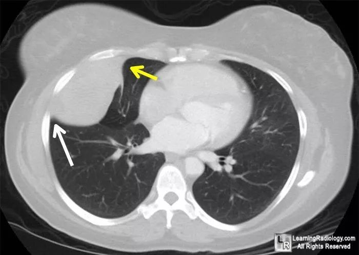胸膜纤维瘤,你了解吗?│以影识病