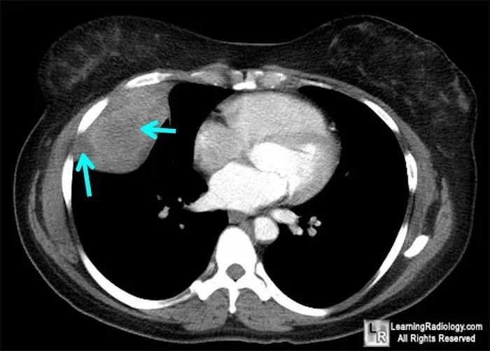 胸膜纤维瘤,你了解吗?│以影识病