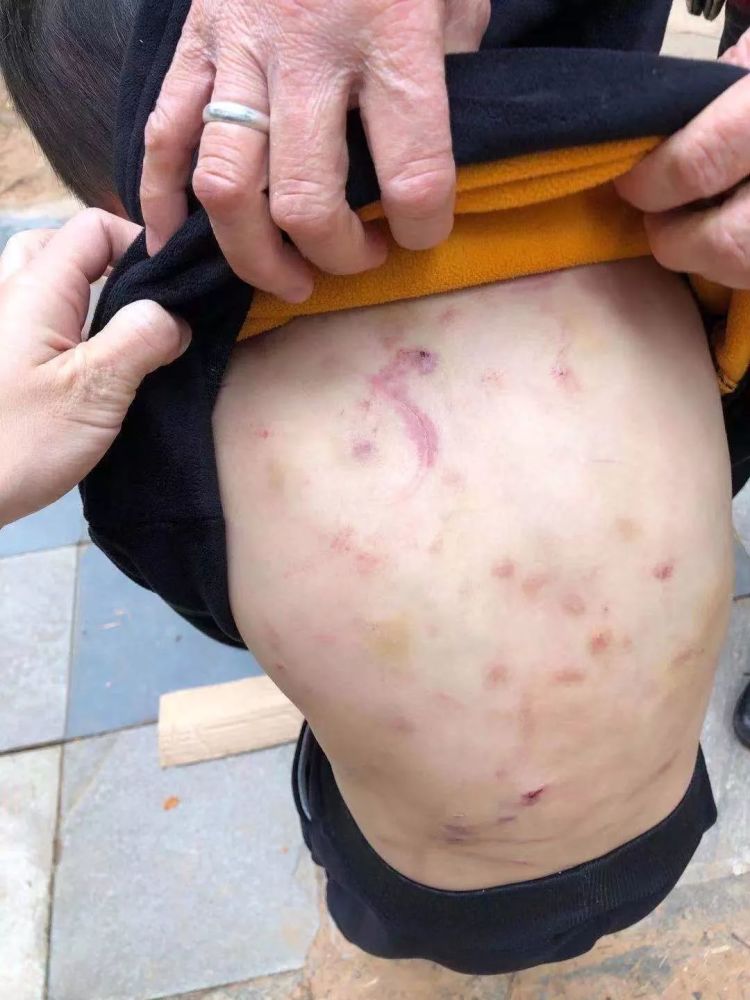 广西5岁男孩遭亲生父亲毒打,图片触目惊心_腾讯新闻