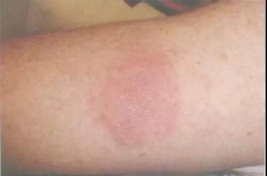 让比伯和艾薇儿双双中招的莱姆病,到底是种什么病?