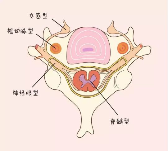 顯微鏡下頸椎前路acdf治療脊髓型頸椎病