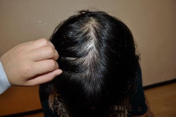 头皮出油太疯狂,头发总是油腻腻的,医生解释:这3个原因要明白