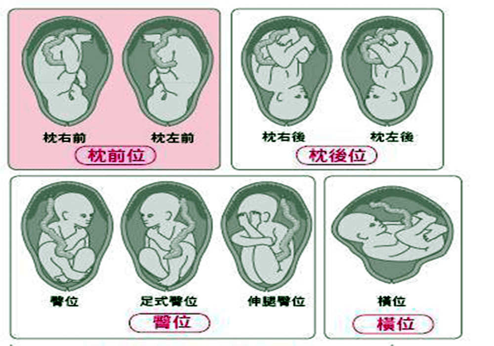 此外,头位还可以细分为 枕先露,前囟先露,额先露,面先露,其中枕先露还