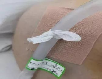 将医用无菌敷料(i)打开后,以胸腔闭式引流管上下连接处粘贴固定图