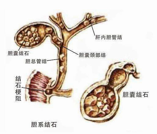 膽總管結石反覆發作折磨人這幾個早期症狀你得先了解