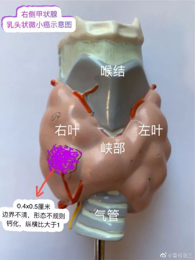 多次b超提示甲状腺结节恶性,下一步怎么办?