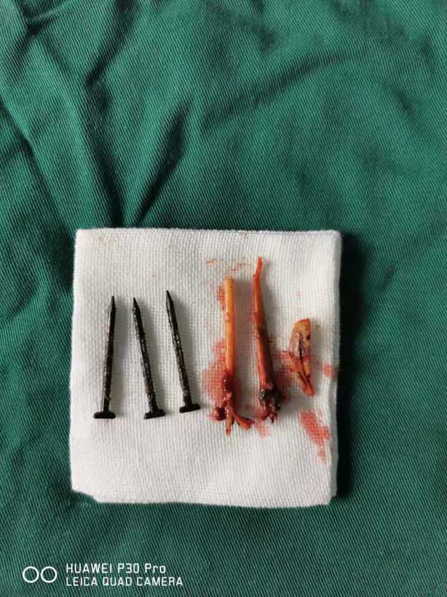 近日,南阳一22岁小伙因牙疼难忍,心中焦虑,自行用铁钉,牙签等沿牙根