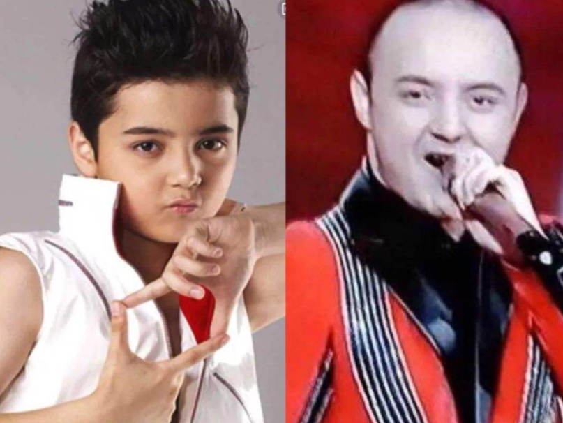 著名童星阿尔法18岁秃顶,颜值堪忧,如今植发成功帅出新高度_腾讯新闻