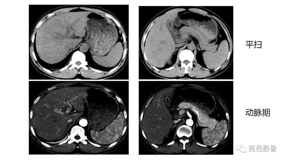 哪些疾病可致肝内门静脉周围间隙增宽