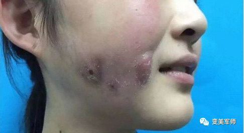 揭秘溶脂针的真实面貌每个注射环节都暗藏风险