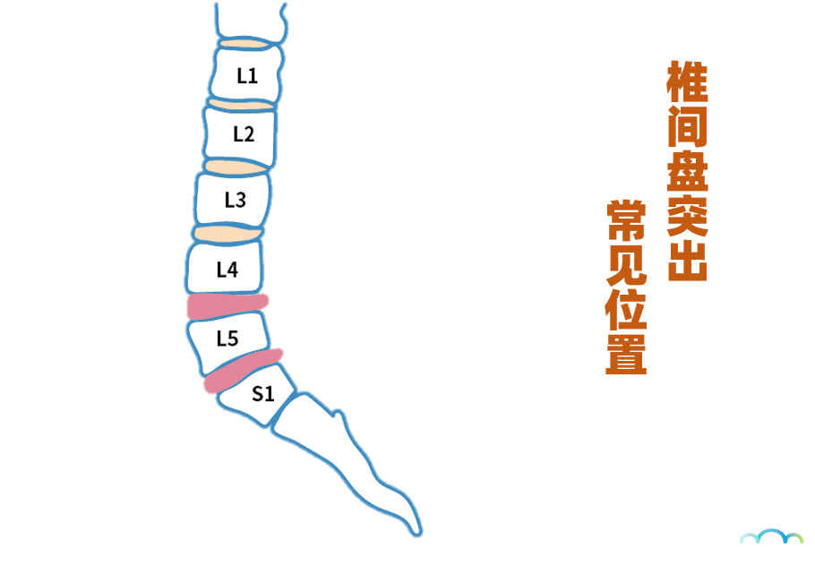 第五節(l5)腰椎間,以及第五節腰椎與骶椎(s1);另外也有可能發生在頸椎