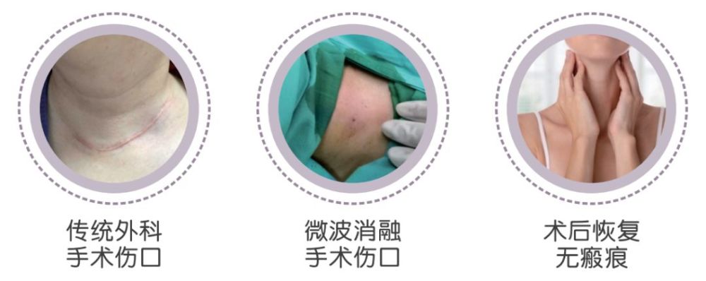 除了手术以外,还能够通过 微波消融技术治疗甲状腺结节.