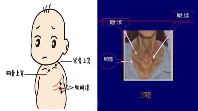 客觀上:吸氣時出現