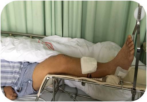 骨牵引的创新护理小发明,真的很实用!骨科病人有福了