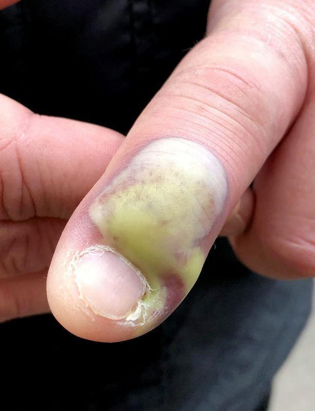 英国男子平时喜欢咬指甲,导致手指严重感染危及生命,所幸死里逃生