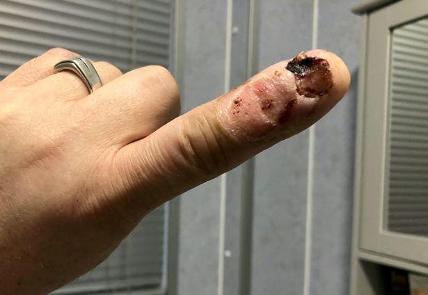 英国男子平时喜欢咬指甲,导致手指严重感染危及生命,所幸死里逃生