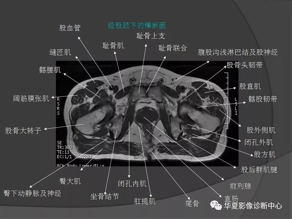 骨盆肌肉解剖mri標識