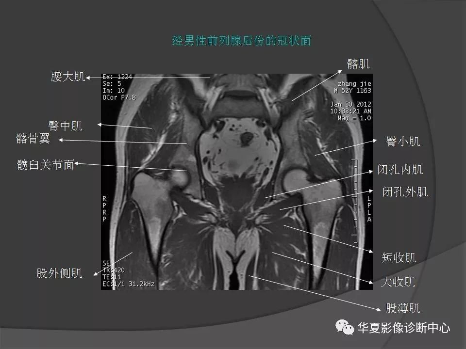 骨盆肌肉解剖mri标识