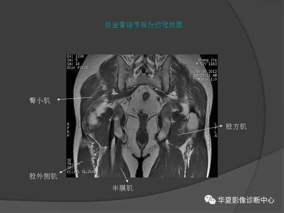 骨盆肌肉解剖mri標識