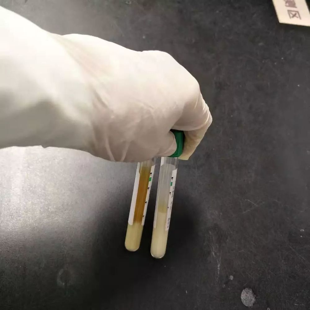 渗出液or漏出液明明白白分一分