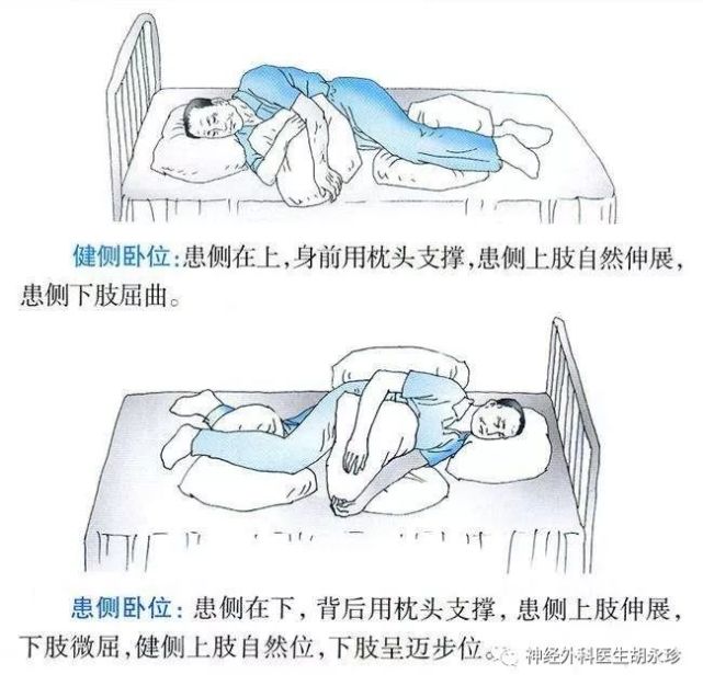 脑出血后的功能恢复
