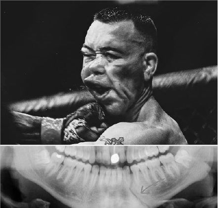 一拳打断对手下巴!他就是"中国mma一哥"李景亮的最强劲敌!