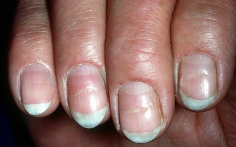 除了糖尿病外,出现"博氏线"的其他原因还包括营养不良(比如缺锌),外周