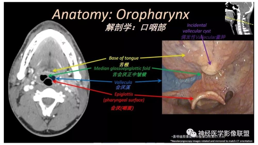 一看就會 | 內窺鏡對照的咽喉部ct解剖