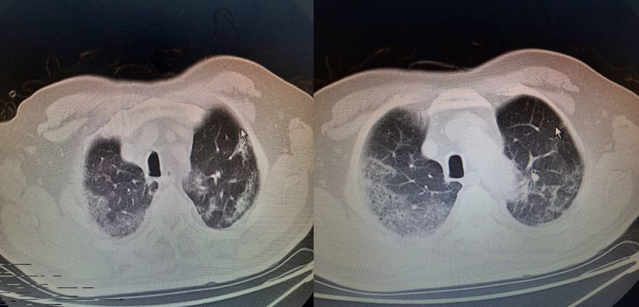 同是重症肺炎为何73岁患者治愈54岁患者死亡