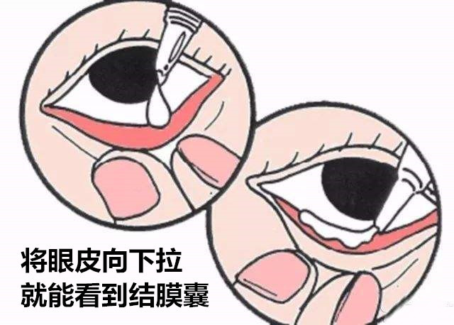 应避免揉眼,及时就近给予大量流动清洁水持续冲洗结膜囊30-60分钟