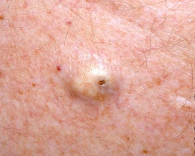 图片来源:uptodate表皮样囊肿是最常见的皮肤囊肿,起源于毛囊漏斗部
