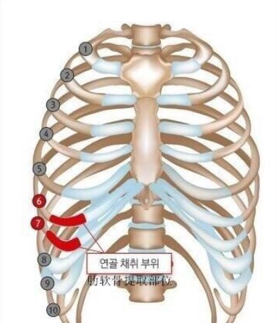 ▋既然避免不了取出肋软骨步骤,为什么有半肋和全肋之分呢?